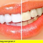 روش های سفید کردن دندان