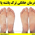 درمان خانگی ترک پاشنه پا