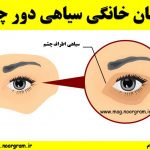 درمان خانگی سیاهی دور چشم