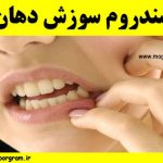 سندروم سوزش دهان