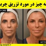 همه چیز در مورد تزریق چربی