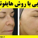 آشنایی با روش هایفوتراپی