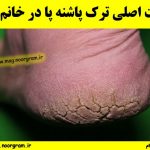 علت اصلی ترک پاشنه پا در خانم ها