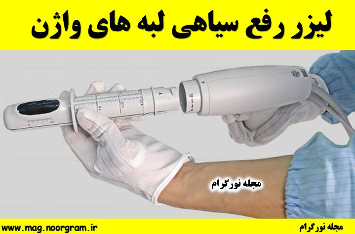 لیزر رفع سیاهی لبه های واژن