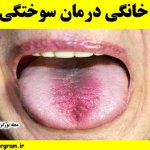 روش خانگی درمان سوختگی زبان