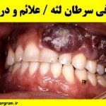 معرفی سرطان لثه علائم و درمان