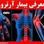 معرفی بیمار آرتروز