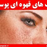 علت لکه های قهوه ای پوست