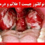 منونوکلئوز چیست ؟ علائم و درمان