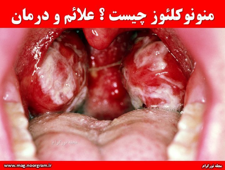 منونوکلئوز چیست ؟ علائم و درمان