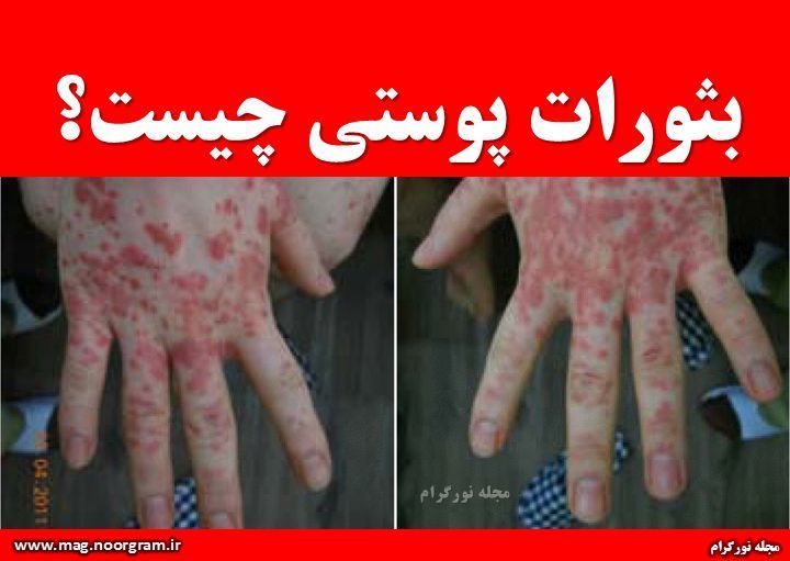 بثورات پوستی چیست