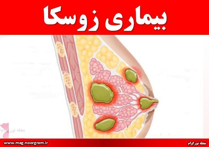 بیماری زوسکا