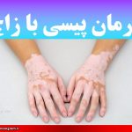 درمان پیسی با زاج