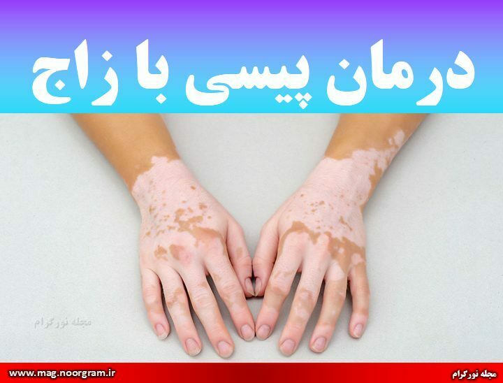 درمان پیسی با زاج