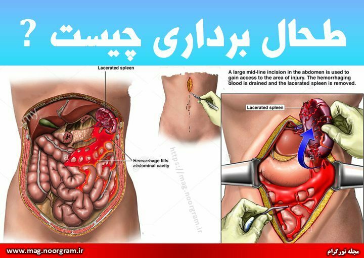 طحال برداری چیست